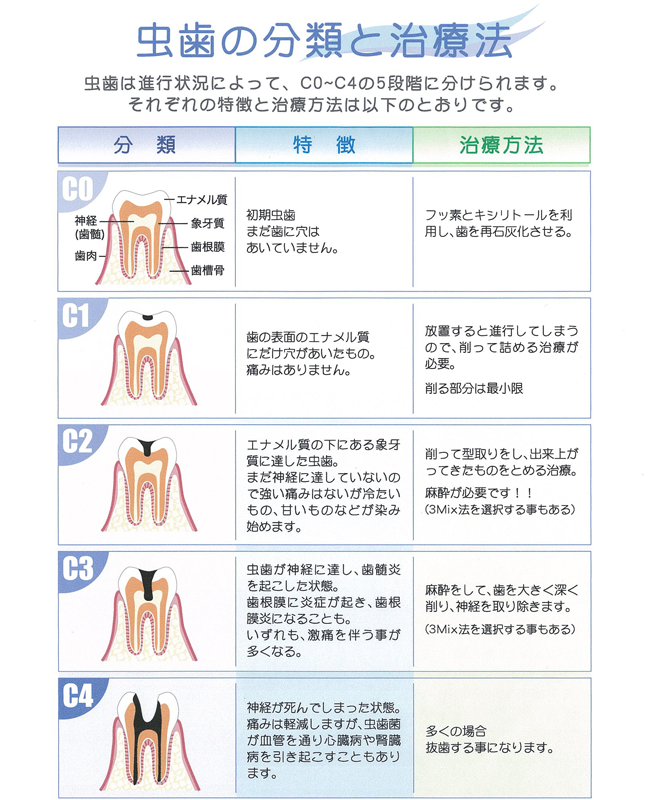 虫歯の分類と治療法