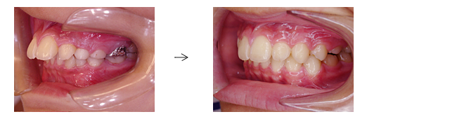 上顎前突（出っ歯）でお悩みの方