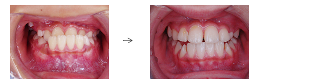 下顎前突（受け口）でお悩みの方