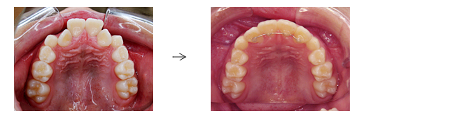 歯がガタガタでお悩みの方（叢生/乱杭歯の症例）