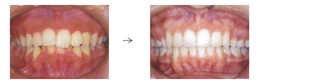 歯がガタガタでお悩みの方（叢生/乱杭歯の症例）